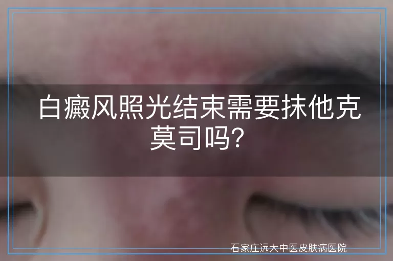 白癜风照光结束需要抹他克莫司吗？