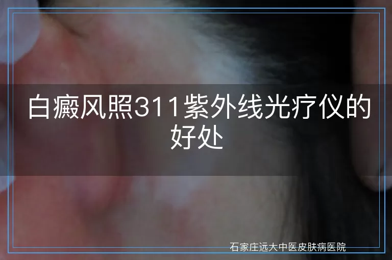 白癜风照311紫外线光疗仪的好处