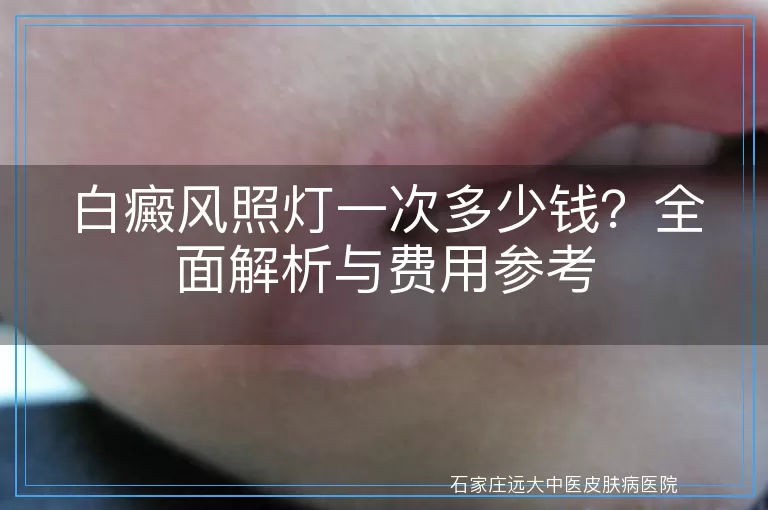 白癜风照灯一次多少钱？全面解析与费用参考