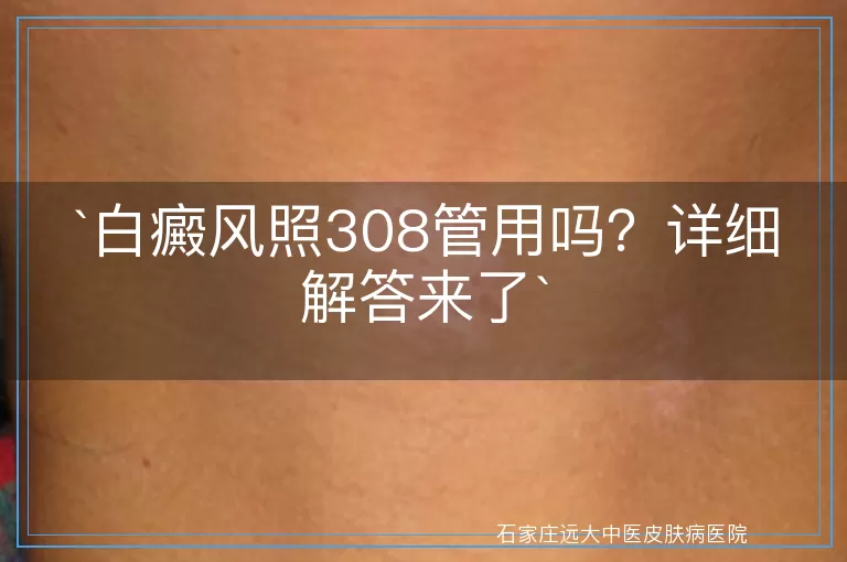 白癜风照308管用吗？详细解答来了