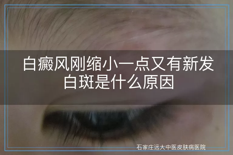 白癜风刚缩小一点又有新发白斑是什么原因