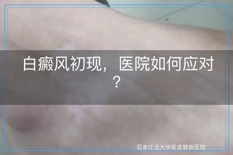 白癜风初现，医院如何应对？