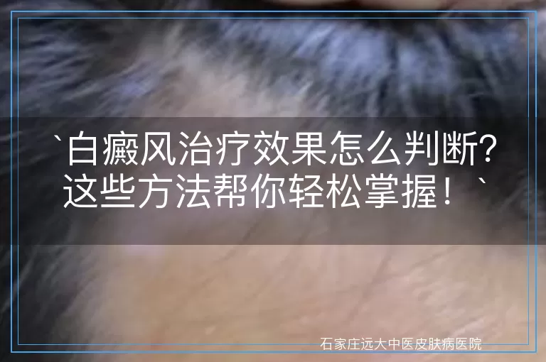 白癜风治疗效果怎么判断？这些方法帮你轻松掌握！