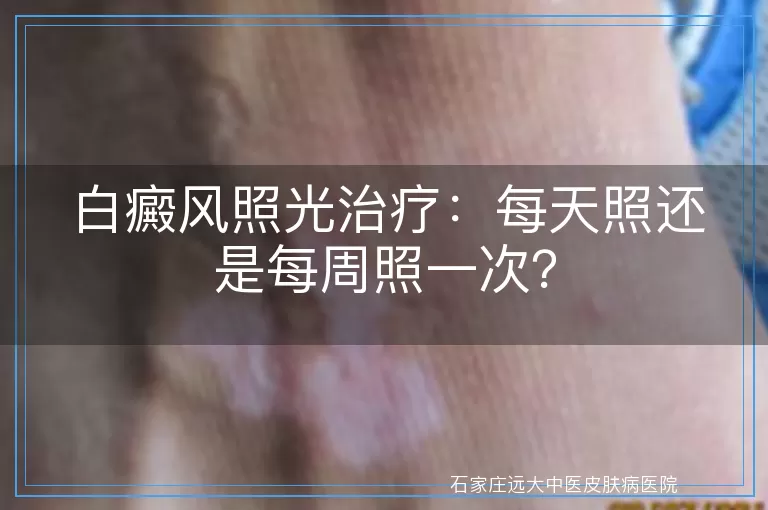 白癜风照光治疗：每天照还是每周照一次？