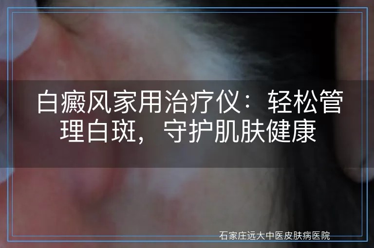 白癜风家用治疗仪：轻松管理白斑，守护肌肤健康