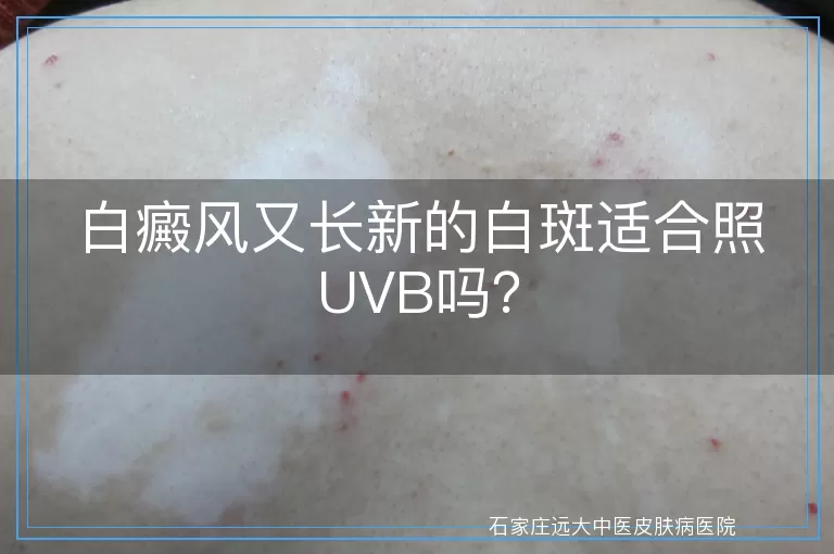 白癜风又长新的白斑适合照UVB吗？