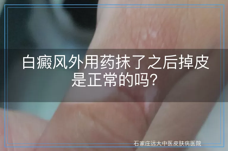 白癜风外用药抹了之后掉皮是正常的吗？