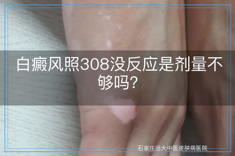 白癜风照308没反应是剂量不够吗？