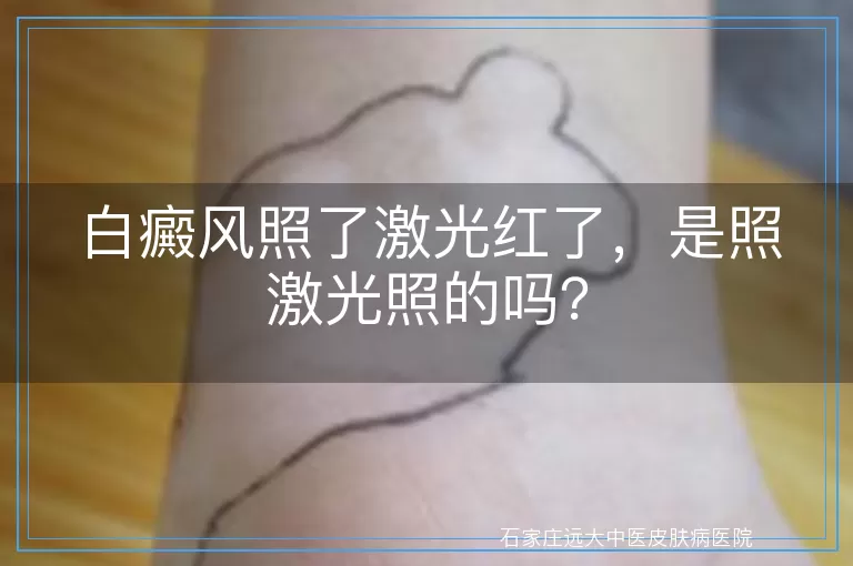 白癜风照了激光红了，是照激光照的吗？