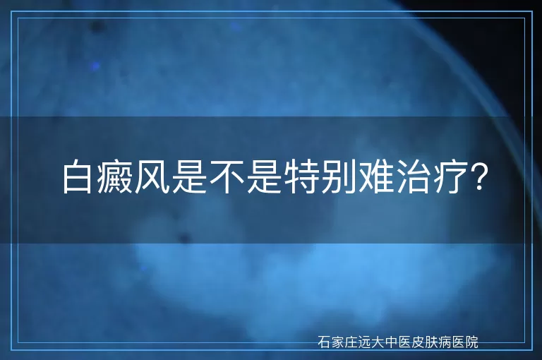 白癜风是不是特别难治疗？