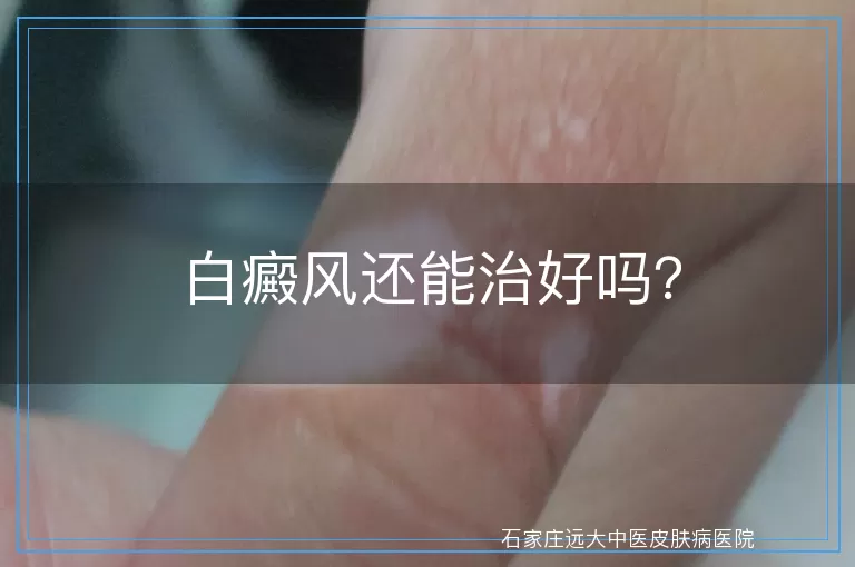 白癜风还能治好吗？