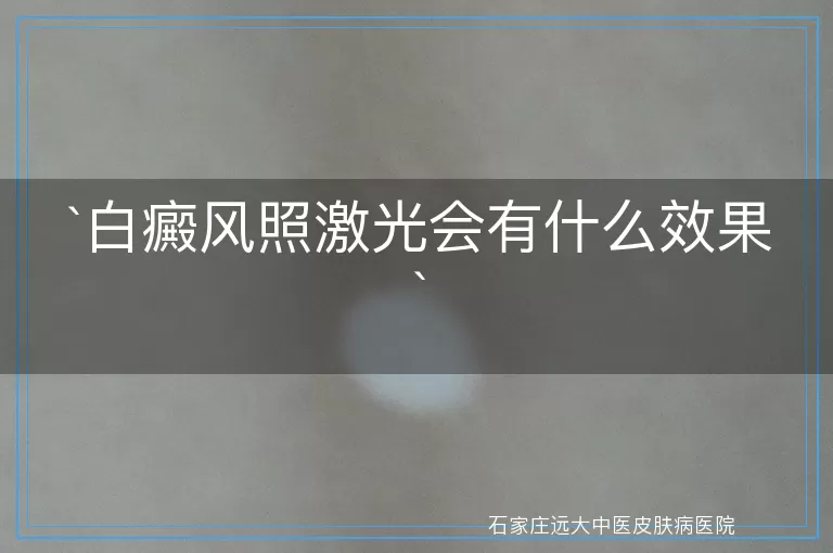 白癜风照激光会有什么效果