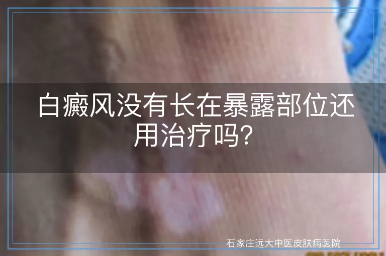 白癜风没有长在暴露部位还用治疗吗？