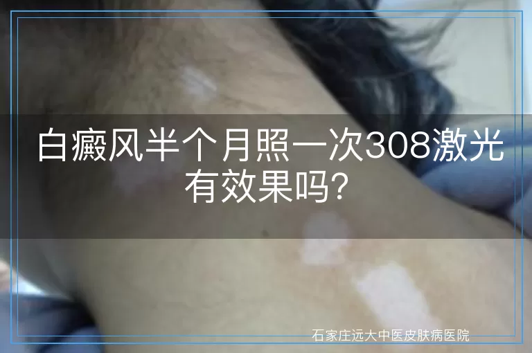 白癜风半个月照一次308激光有效果吗？