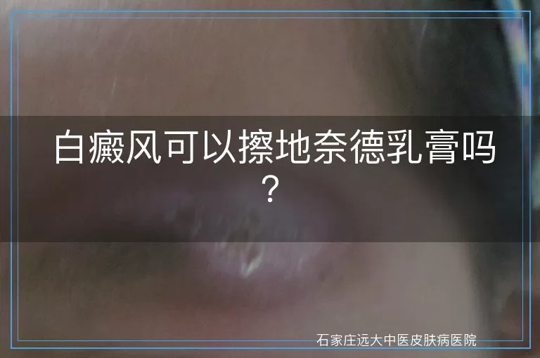 白癜风可以擦地奈德乳膏吗？