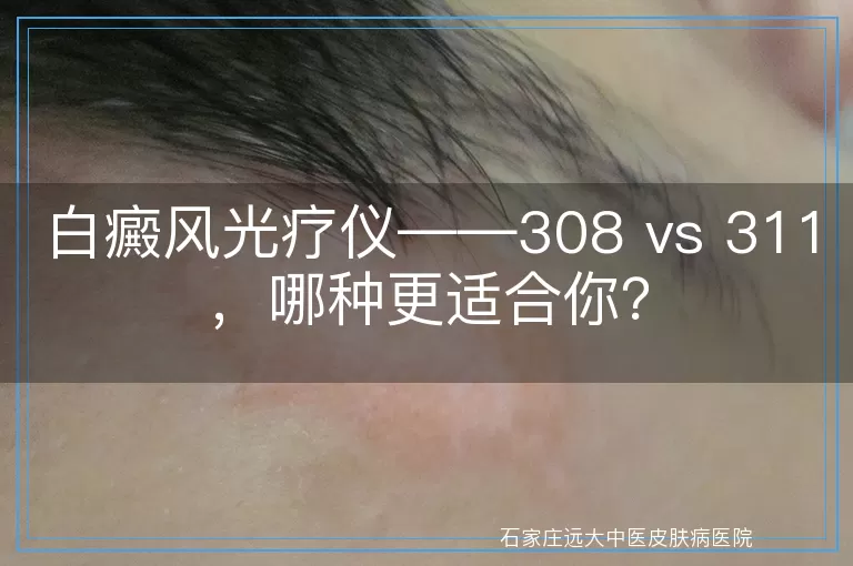白癜风光疗仪——308 vs 311，哪种更适合你？