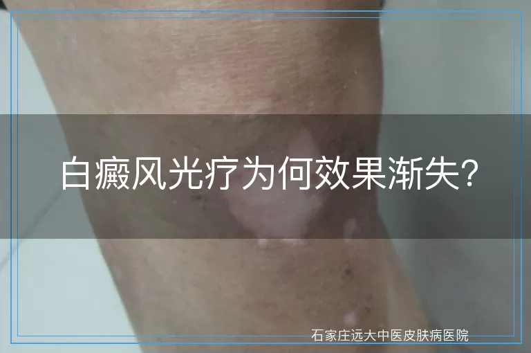 白癜风光疗为何效果渐失？