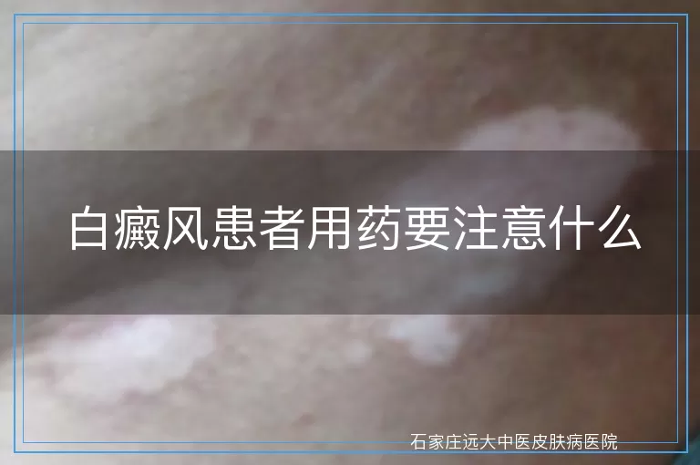 白癜风患者用药要注意什么