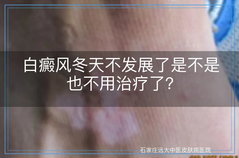 白癜风冬天不发展了是不是也不用治疗了？