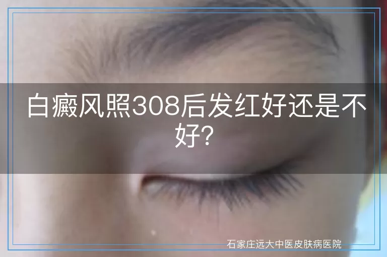白癜风照308后发红好还是不好？