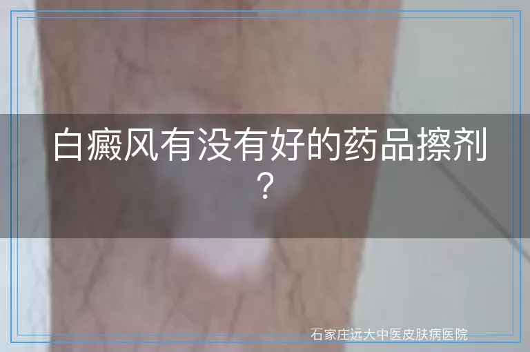 白癜风有没有好的药品擦剂？