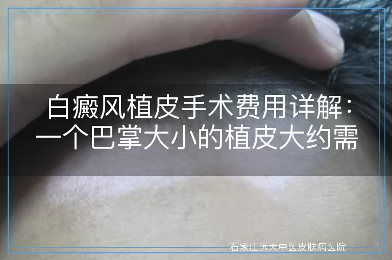 白癜风植皮手术费用详解：一个巴掌大小的植皮大约需要多少钱？
