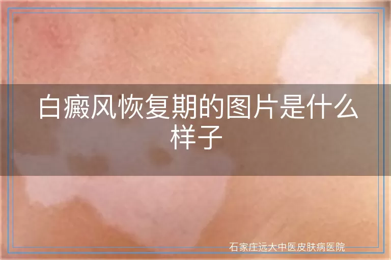 白癜风恢复期的图片是什么样子