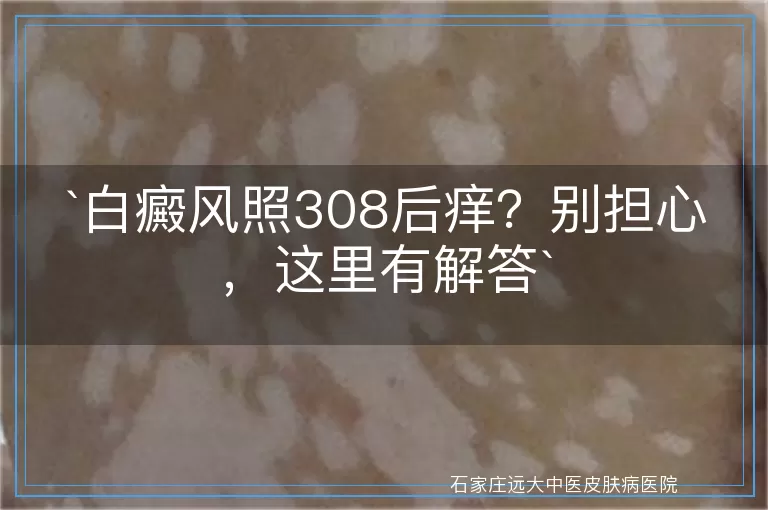 白癜风照308后痒？别担心，这里有解答