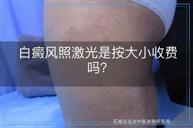 白癜风照激光是按大小收费吗？