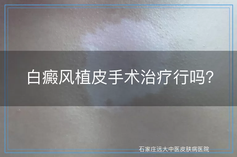 白癜风植皮手术治疗行吗？