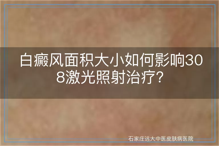 白癜风面积大小如何影响308激光照射治疗？