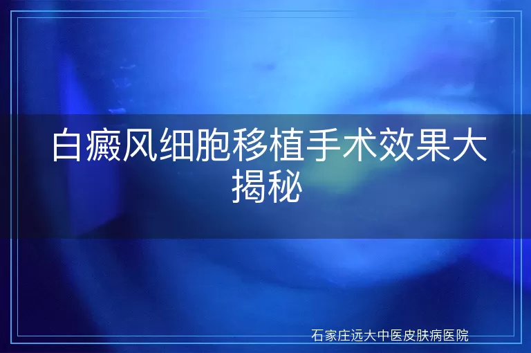 白癜风细胞移植手术效果大揭秘