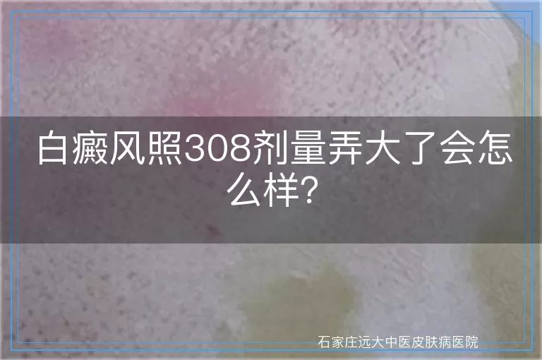 白癜风照308剂量弄大了会怎么样？