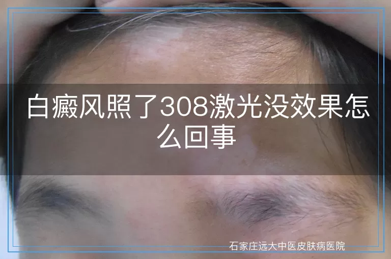 白癜风照了308激光没效果怎么回事