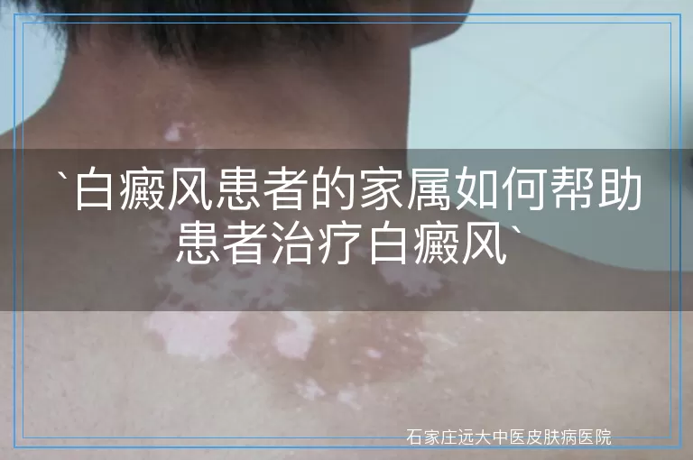 白癜风患者的家属如何帮助患者治疗白癜风