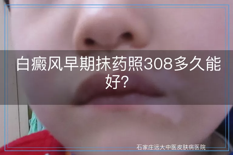 白癜风早期抹药照308多久能好？