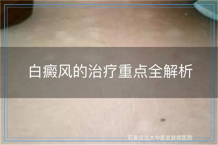 白癜风的治疗重点全解析