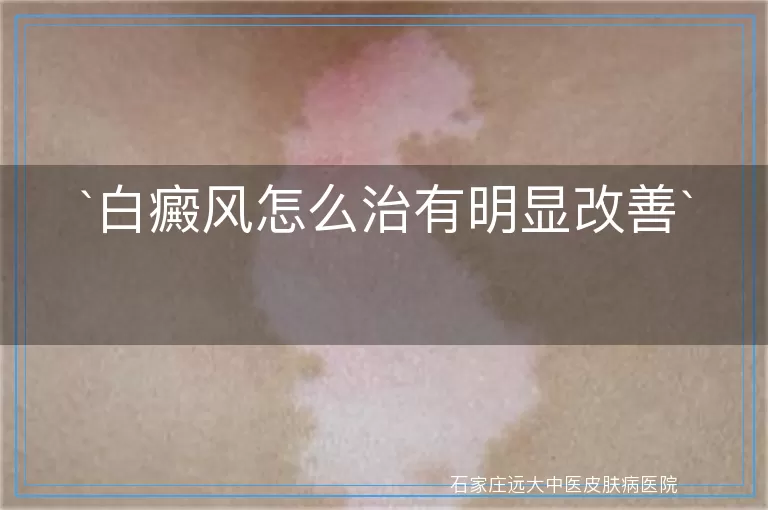 白癜风怎么治有明显改善