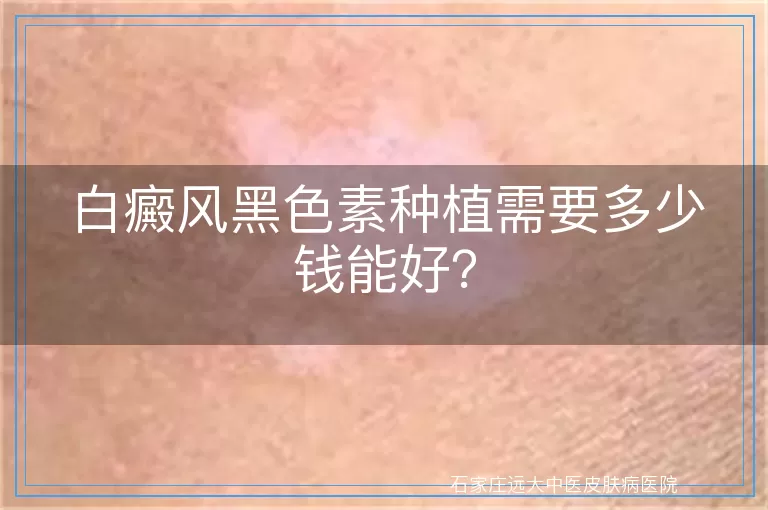 白癜风黑色素种植需要多少钱能好？