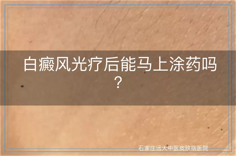 白癜风光疗后能马上涂药吗？