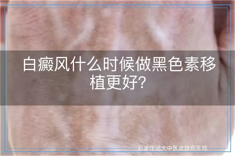 白癜风什么时候做黑色素移植更好?