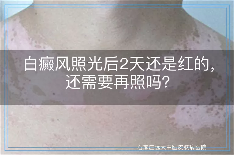 白癜风照光后2天还是红的，还需要再照吗？