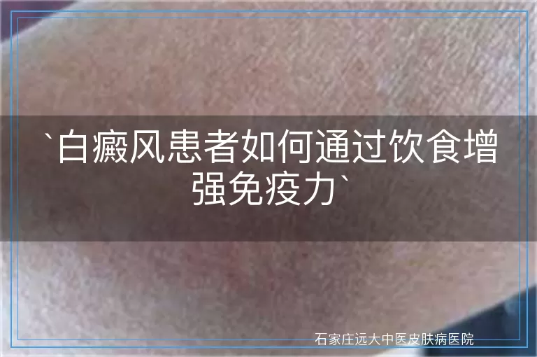 白癜风患者如何通过饮食增强免疫力