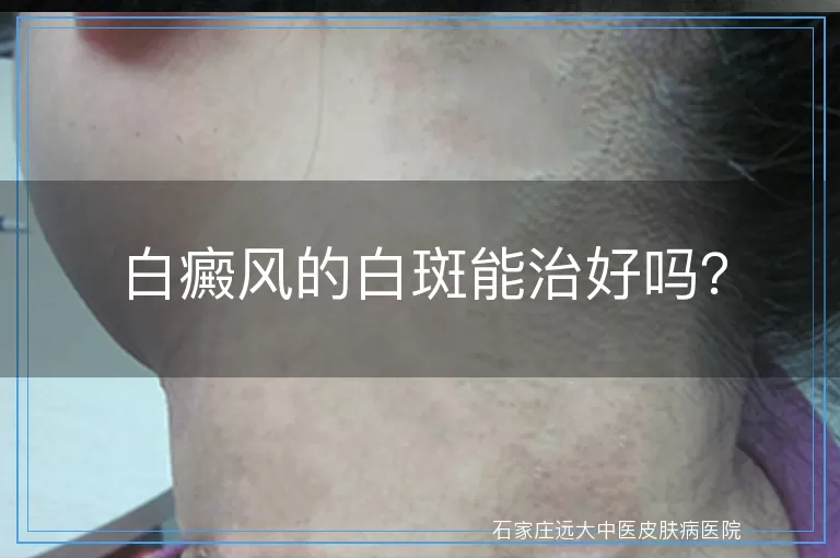 白癜风的白斑能治好吗?