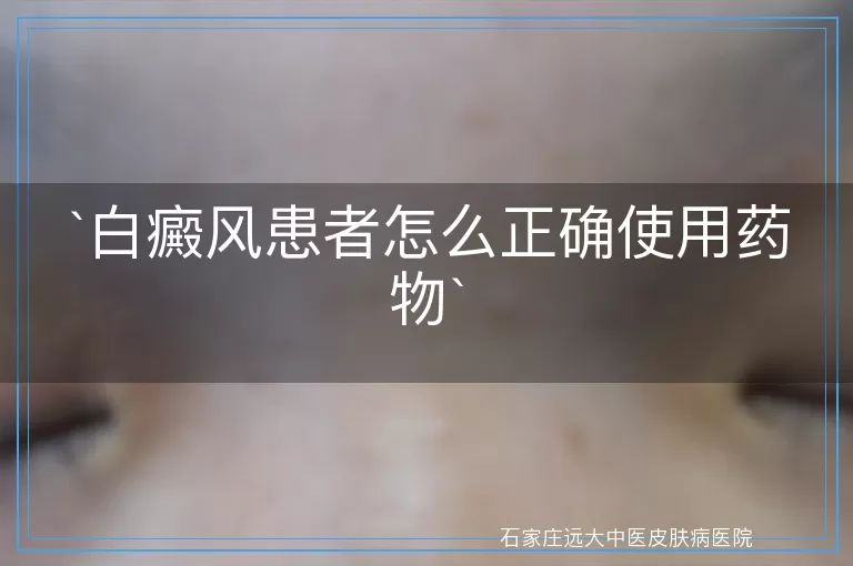白癜风患者怎么正确使用药物