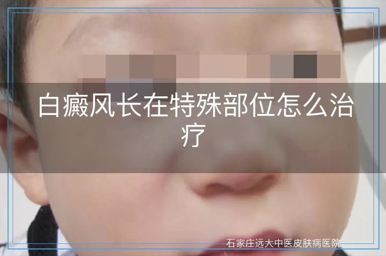 白癜风长在特殊部位怎么治疗