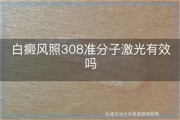 白癜风照308准分子激光有效吗