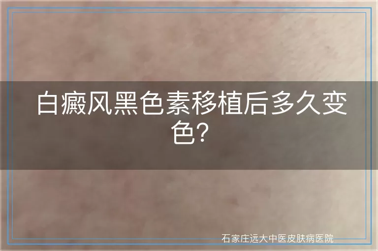 白癜风黑色素移植后多久变色?
