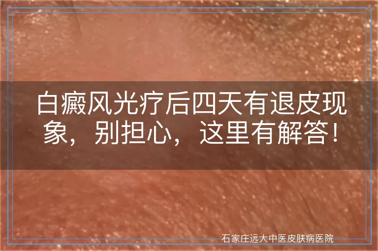 白癜风光疗后四天有退皮现象,别担心,这里有解答!