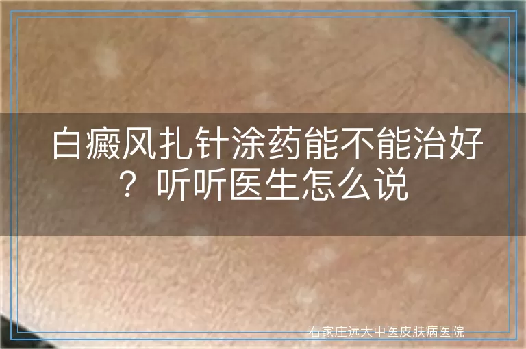 白癜风扎针涂药能不能治好？听听医生怎么说